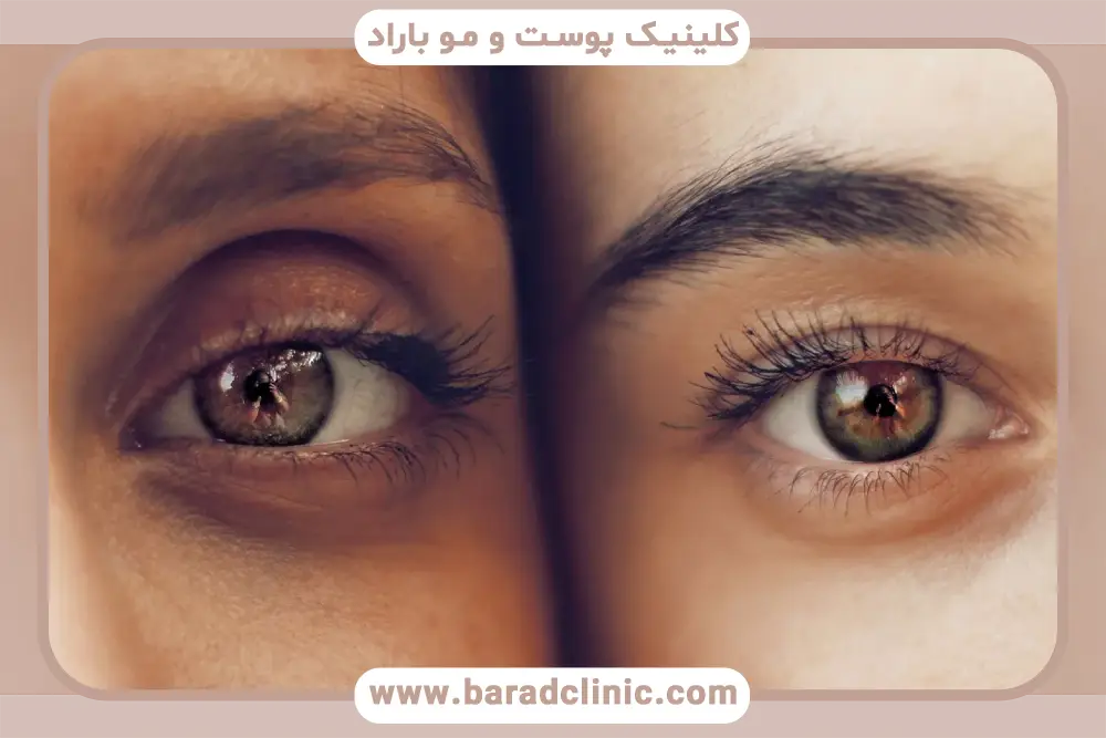 مراحل بلفاروپلاستی گودی زیر چشم 