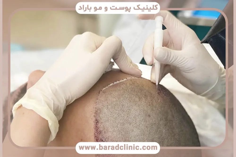 نتیجه کاشت مو بعد از سه ماه در پوست سر