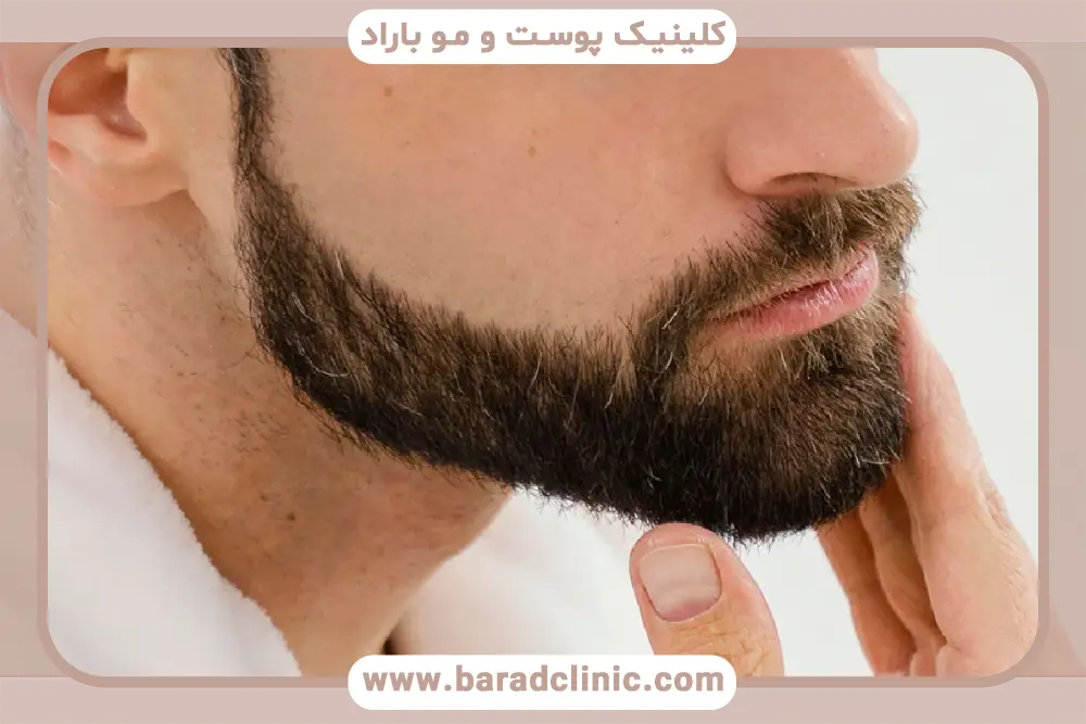 فواید کاشت ریش در پوشاندن نواقص پوست