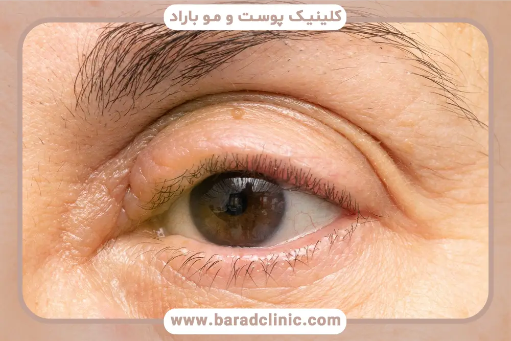 کاندیدای مناسب لیفت شقیقه