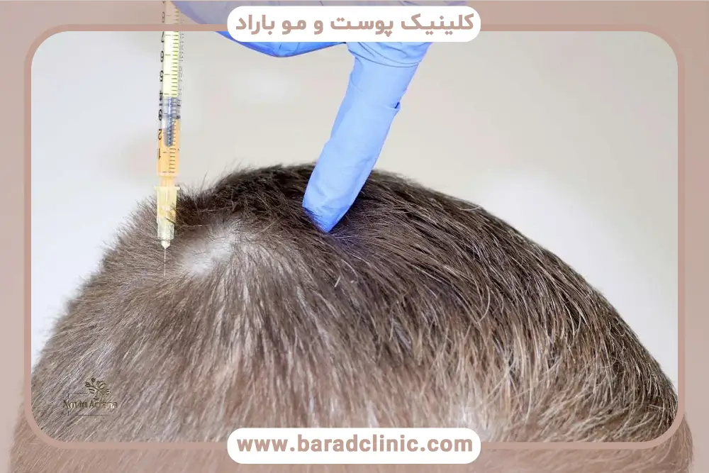 ممنوعیات بعد از کاشت مو در هنگام شستشوی موها