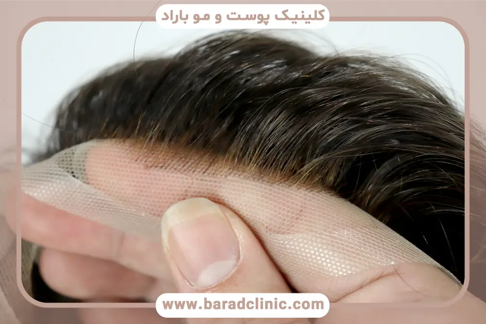 مزایای کاشت مو مصنوعی 