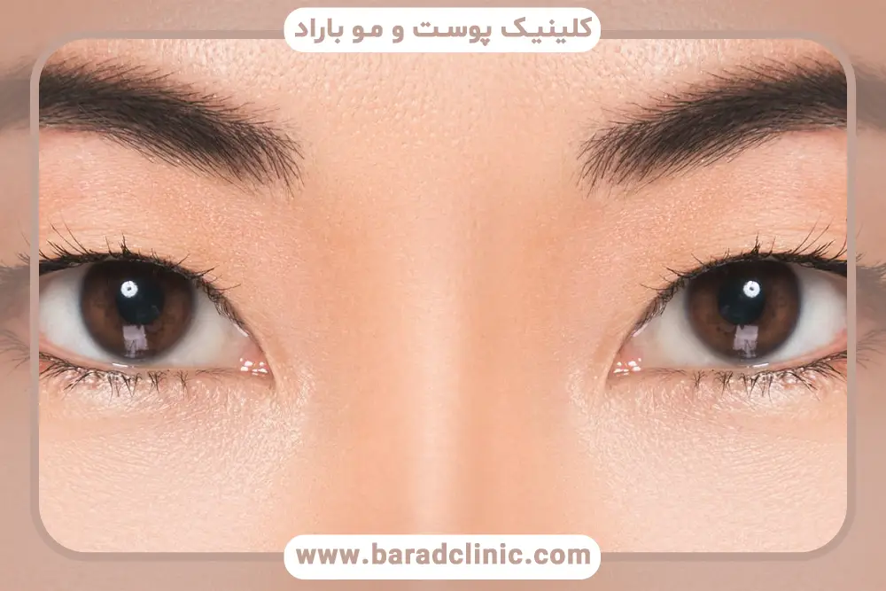 بهترین پزشک بلفاروپلاستی چشم آسیایی 