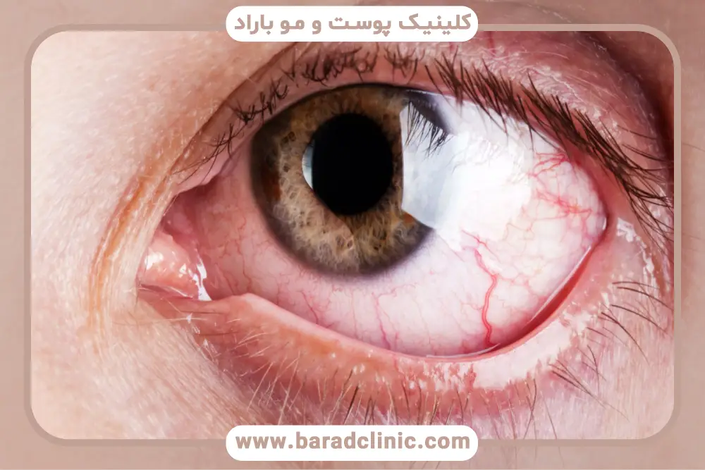 پیشگیری از خشکی چشم بعد از بلفاروپلاستی 