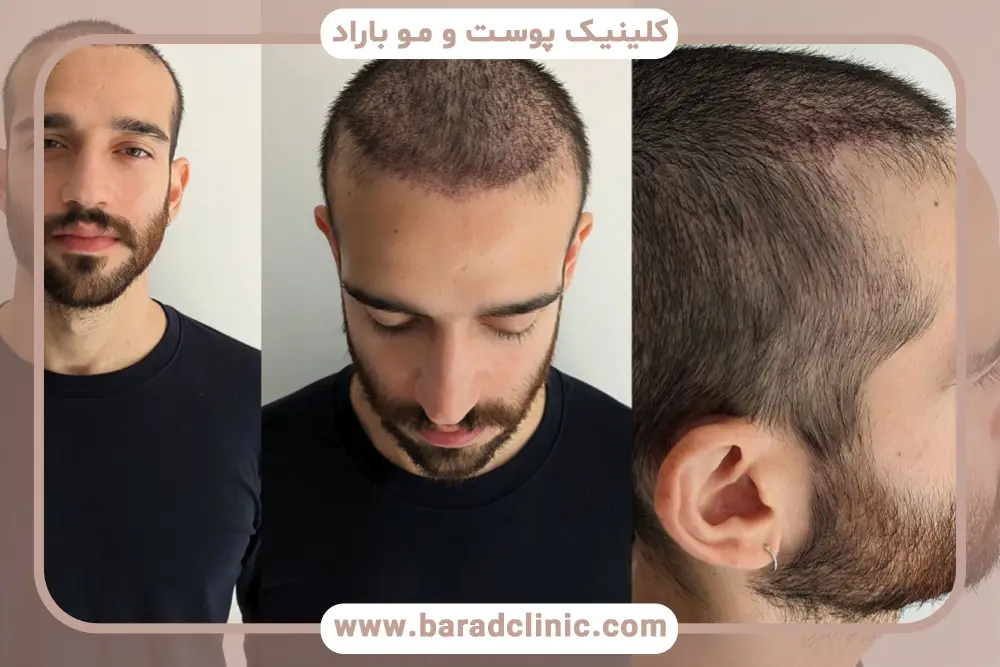 روش کاشت مو FIT