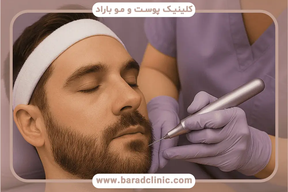 مراحل کاشت ریش روی چانه 