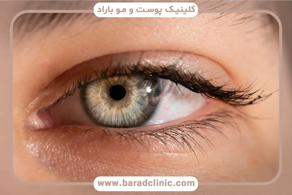 عوامل موثر بر زمان کشیدن بخیه بلفاروپلاستی