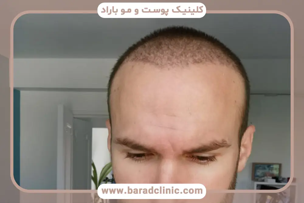 بررسی تراکم موها در عکس کاشت مو بعد از سه ماه 