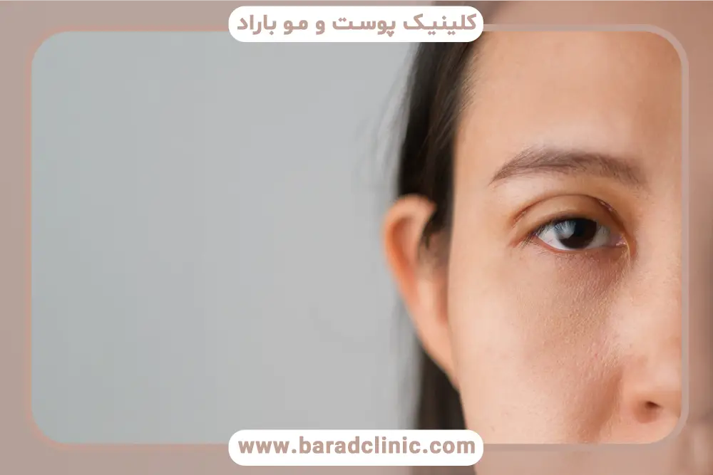 تفاوت تورم معمولی با چسبندگی پلک بعد از بلفاروپلاستی