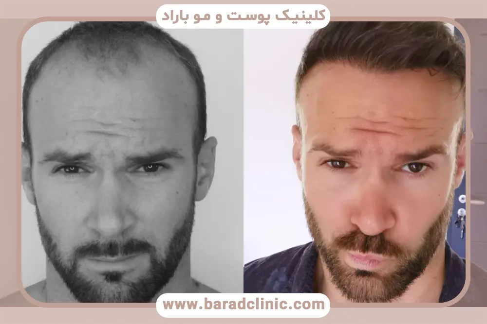 تغییر رنگ و ضخامت در عکس کاشت مو بعد از دو ماه