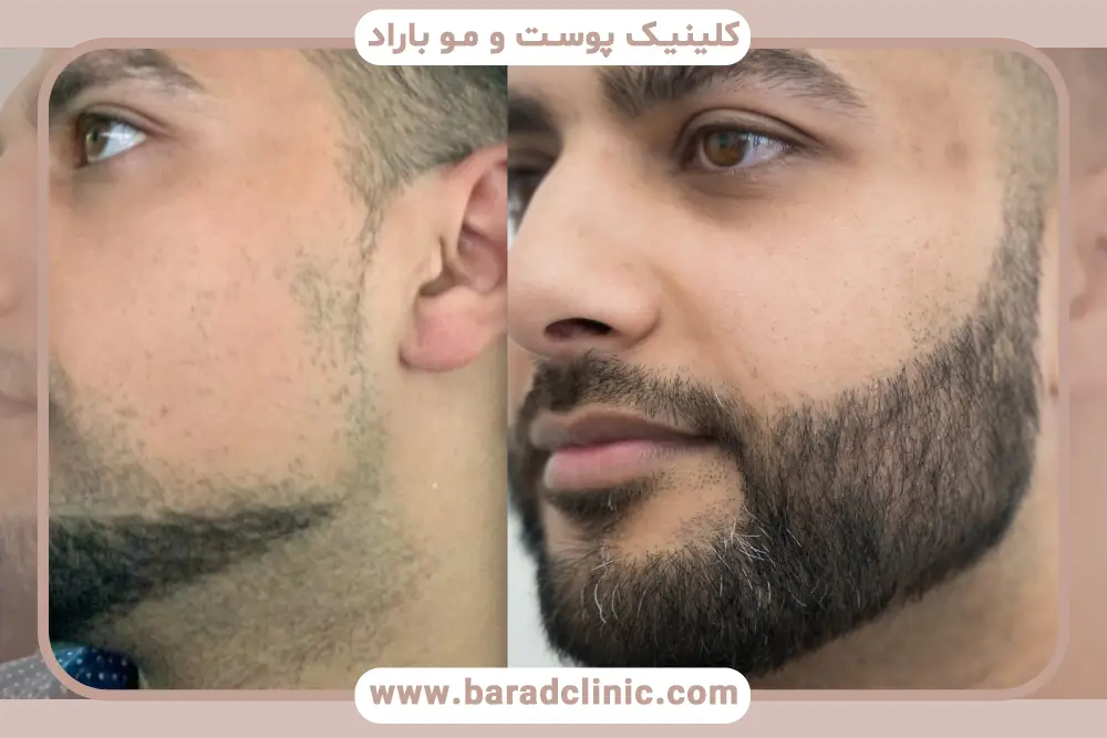 بررسی میزان درد در فیلم کاشت ریش