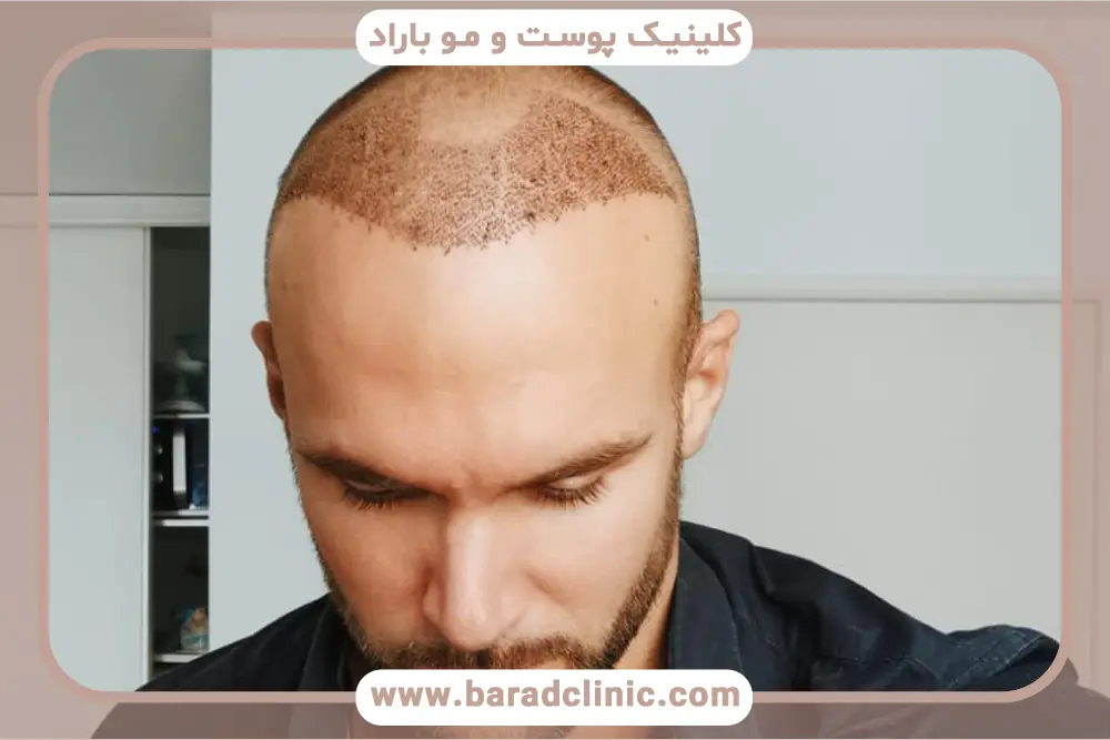 مزایای بهترین روش کاشت مو با تراکم بالا 