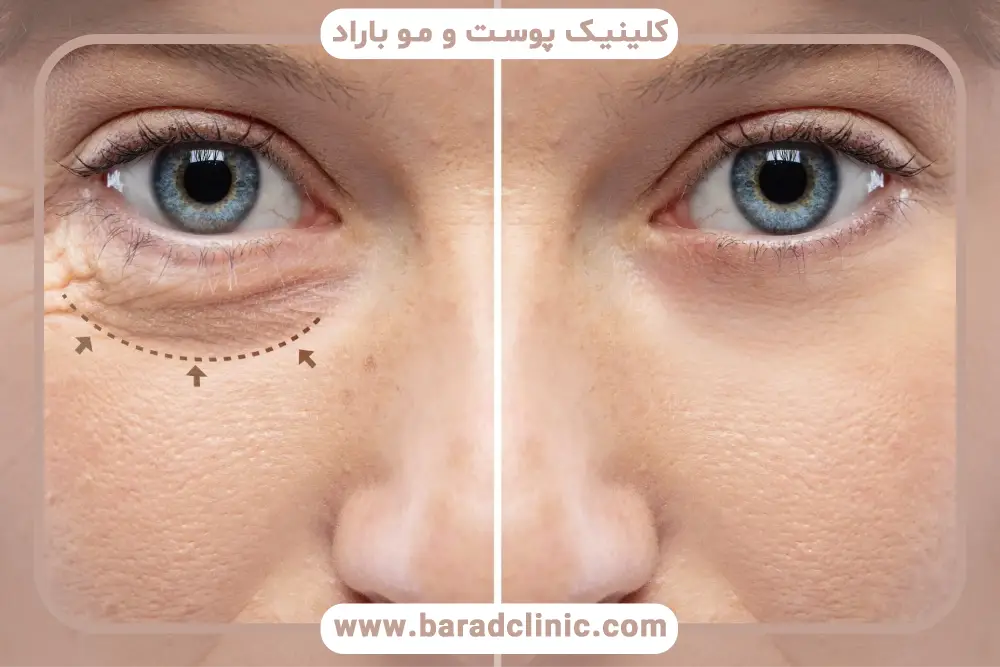 مراقبتهای لازم برای پیشگیری از خونریزی بعد از بلفاروپلاستی