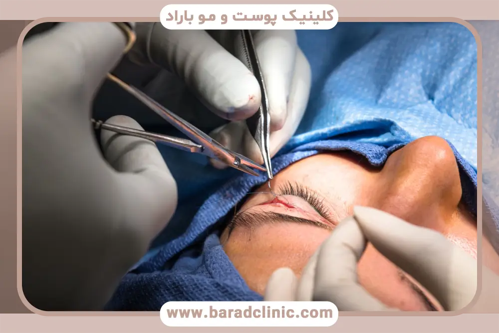 مراقبت‌های لازم برای خط بخیه بلفاروپلاستی