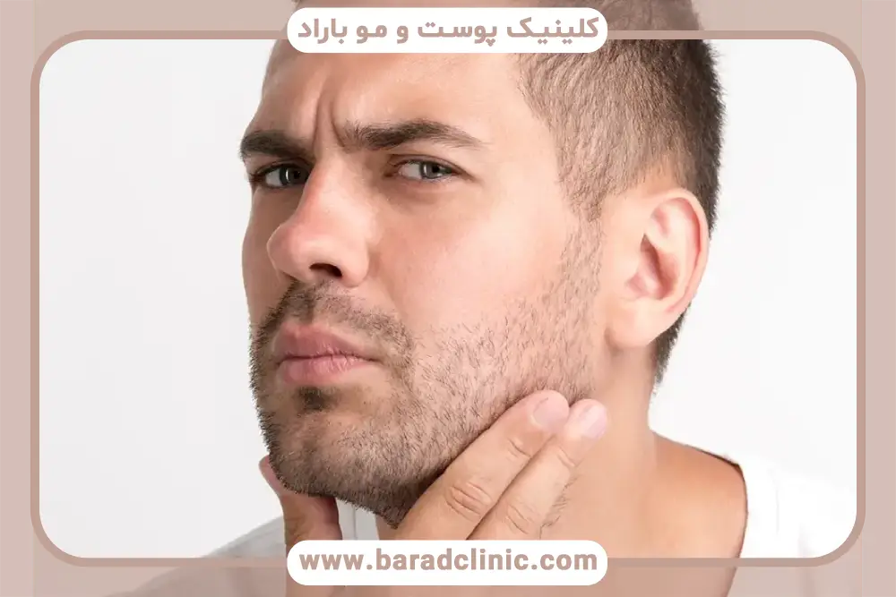 مراقبت‌های بعد از کاشت در بهترین کلینیک کاشت ریش در تهران 