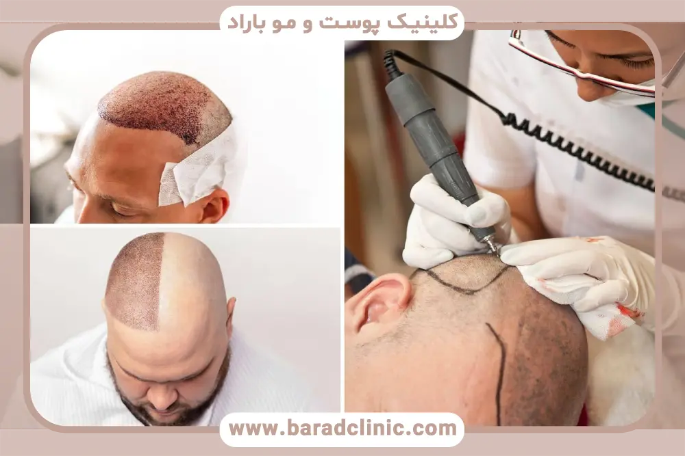 کاشت مو بعد از ۱۰ روز و استراحت کافی