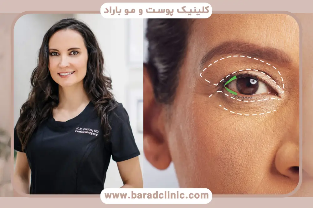 کاندیدای مناسب بلفاروپلاستی در تهران