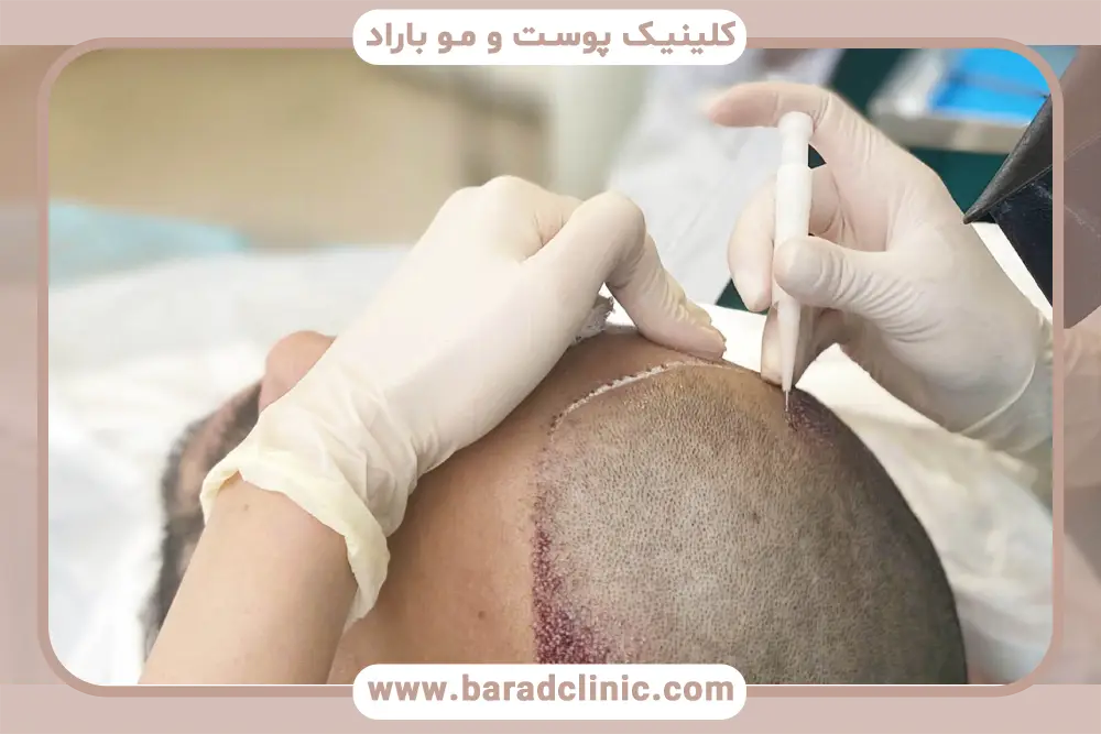 خدمات مشاوره در مرکز کاشت مو تهران
