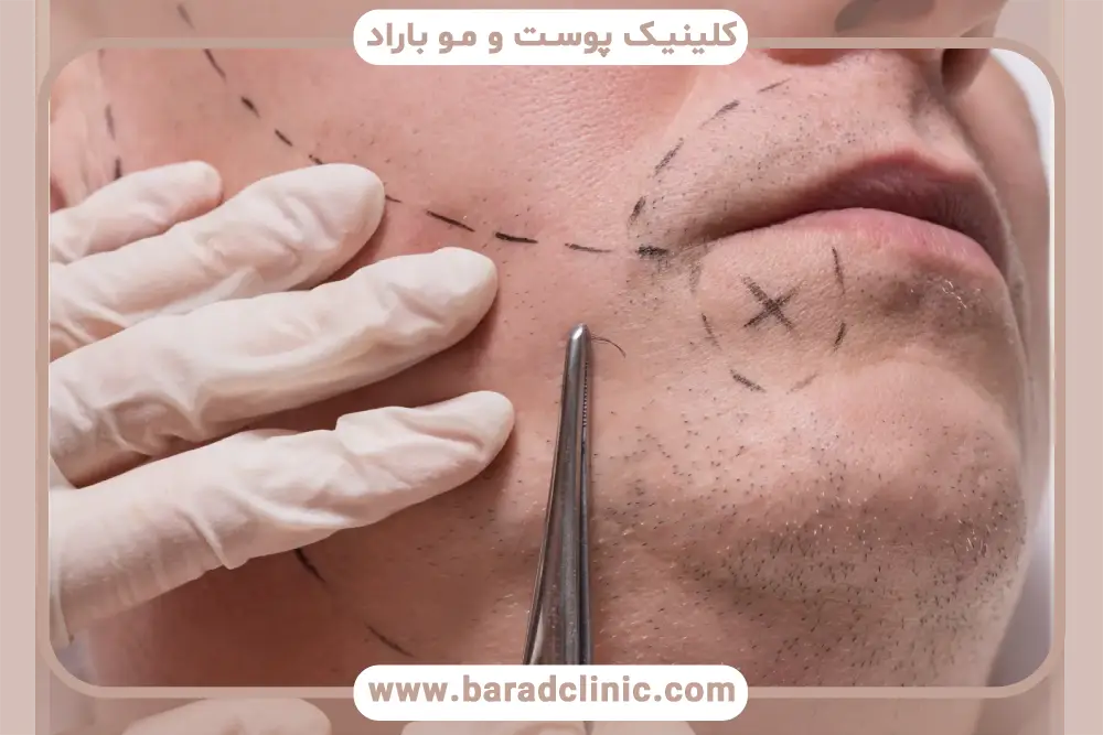 هزینه کاشت ریش اقساطی 