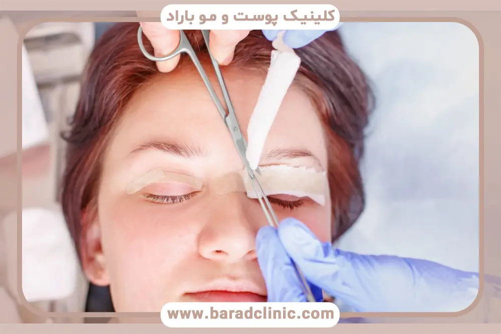 مراقبت‌های قبل و بعد بلفاروپلاستی درمانی