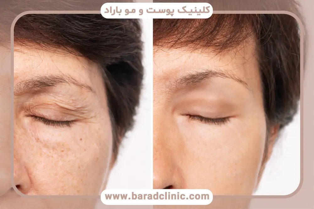 بهترین کلینیک بلفاروپلاستی سرپایی 