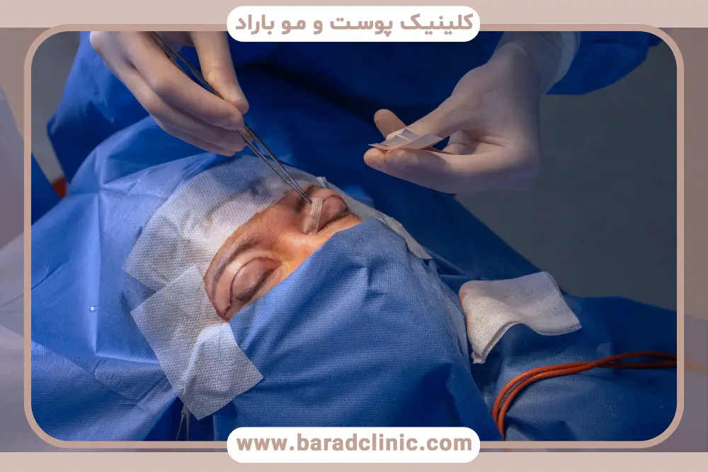 تفاوت‌های روش بلفاروپلاستی با برش و بدون برش