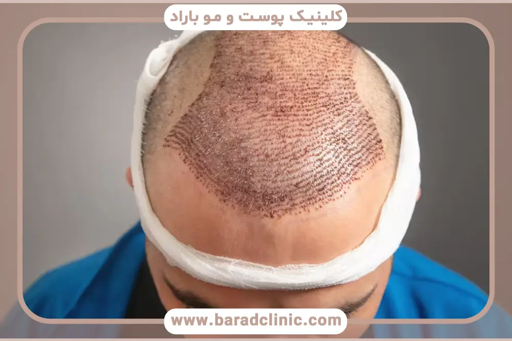 اشتباهات رایج در بررسی عکس کاشت مو