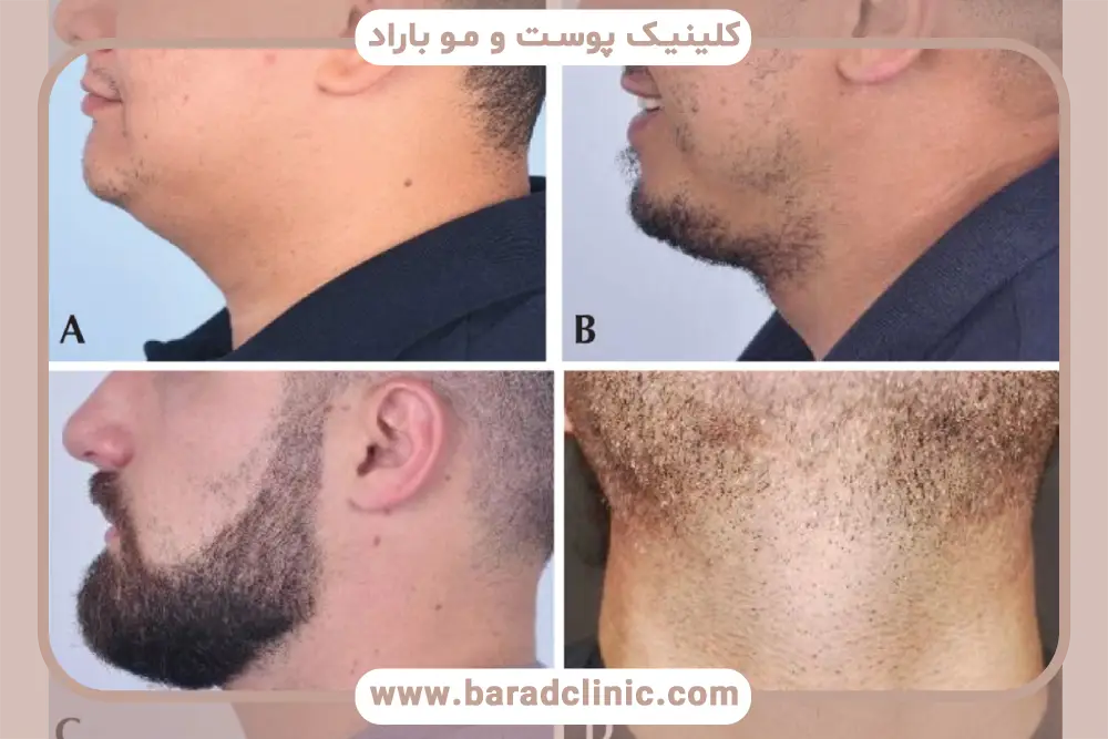 بررسی دقت جراح در نمونه‌های قبل و بعد کاشت ریش 