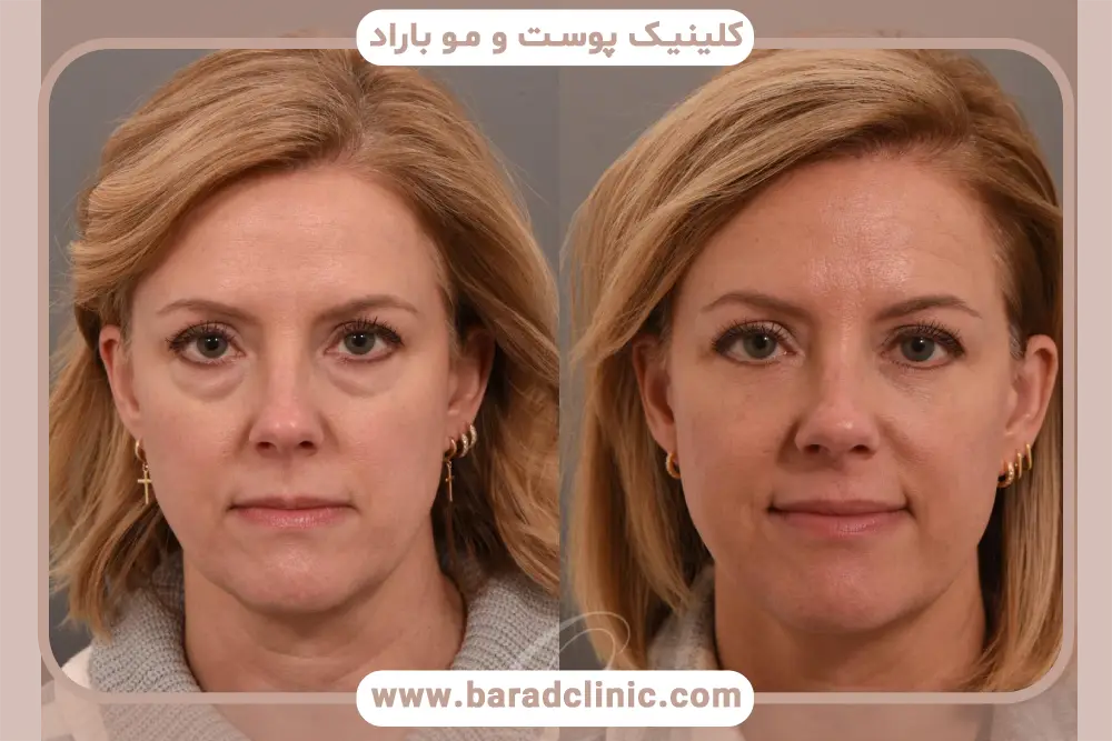 داروهای بلفاروپلاستی روز اول 