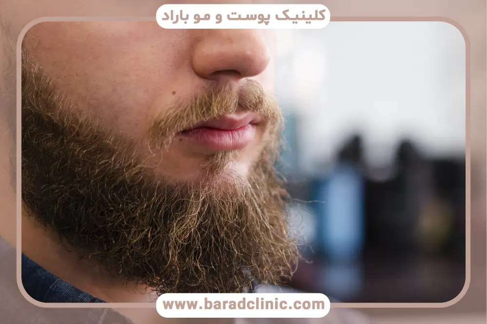 زاویه و نورپردازی در تصاویر کاشت ریش و سبیل قبل و بعد