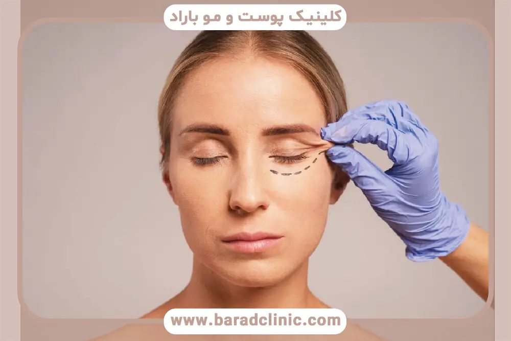 ماندگاری نتایج بلفاروپلاستی ابرو