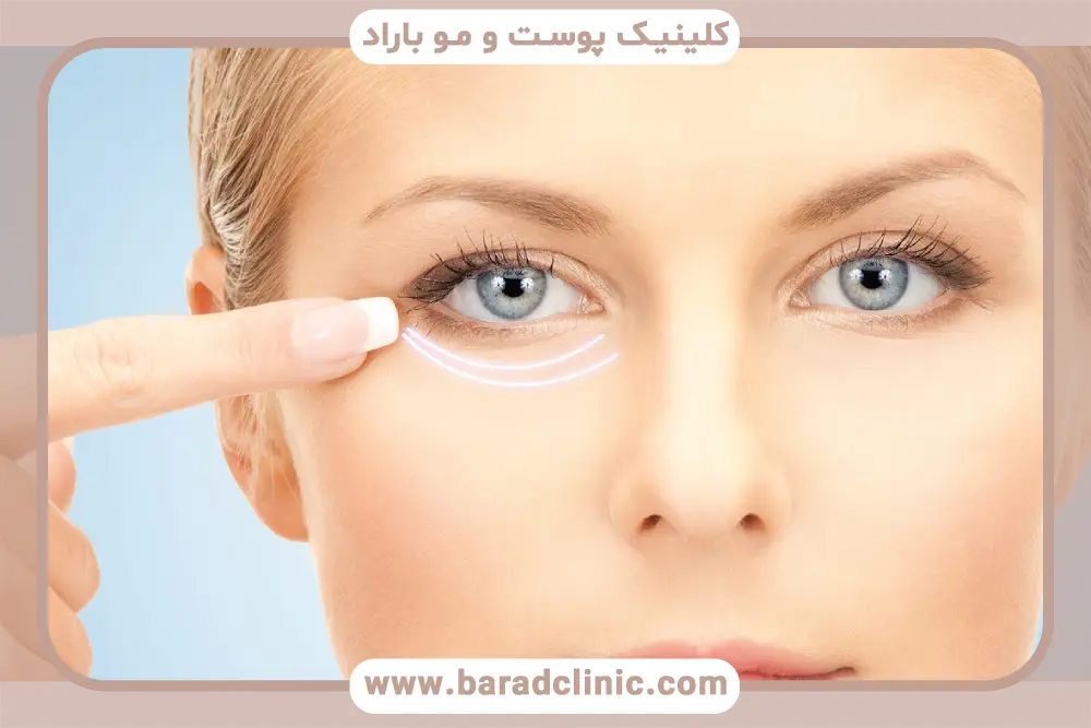 مراقبت‌های قبل از بلفاروپلاستی با لیزر