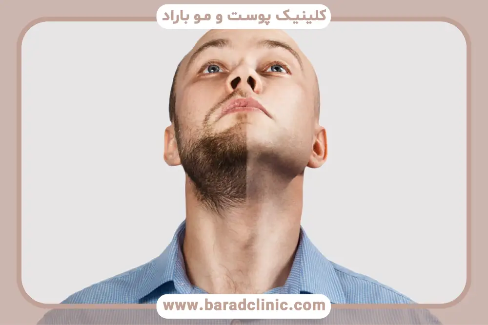 انتظارات واقع‌بینانه یکی از شرایط کاشت ریش 