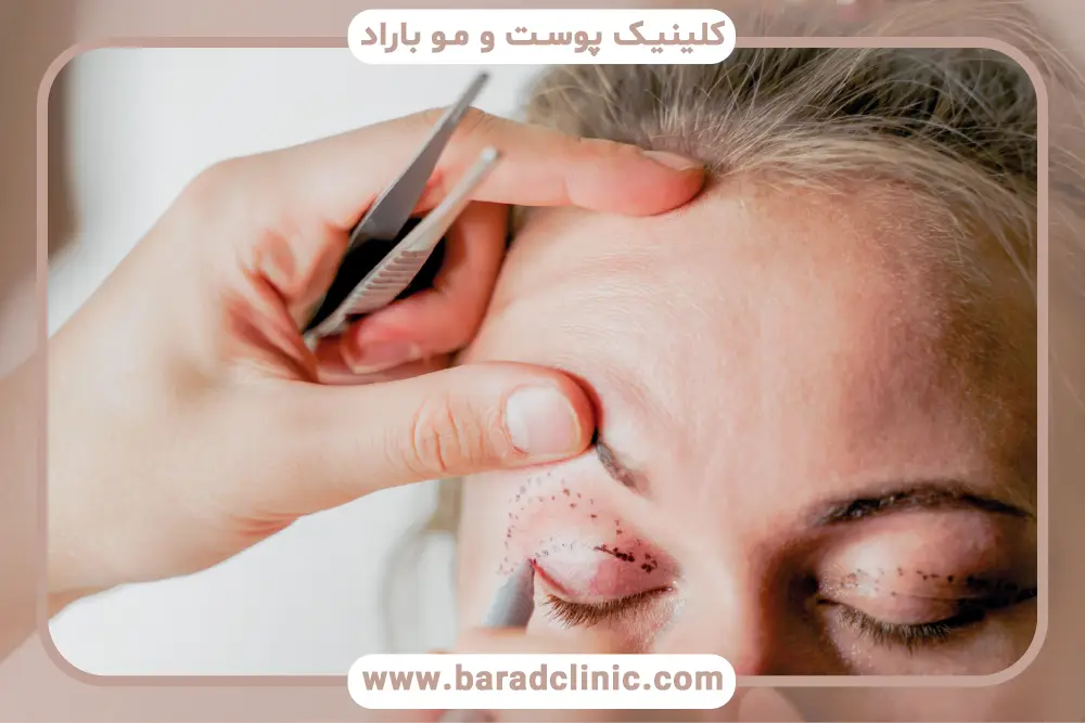 پیشگیری از خطرات بلفاروپلاستی