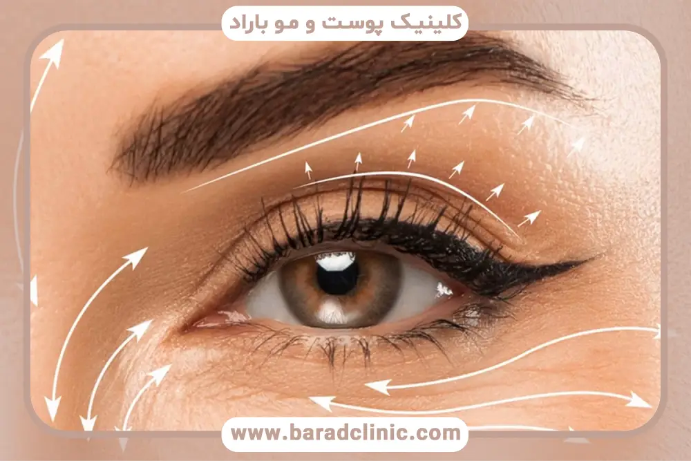 مشاوره کلینیک بلفاروپلاستی تهران 