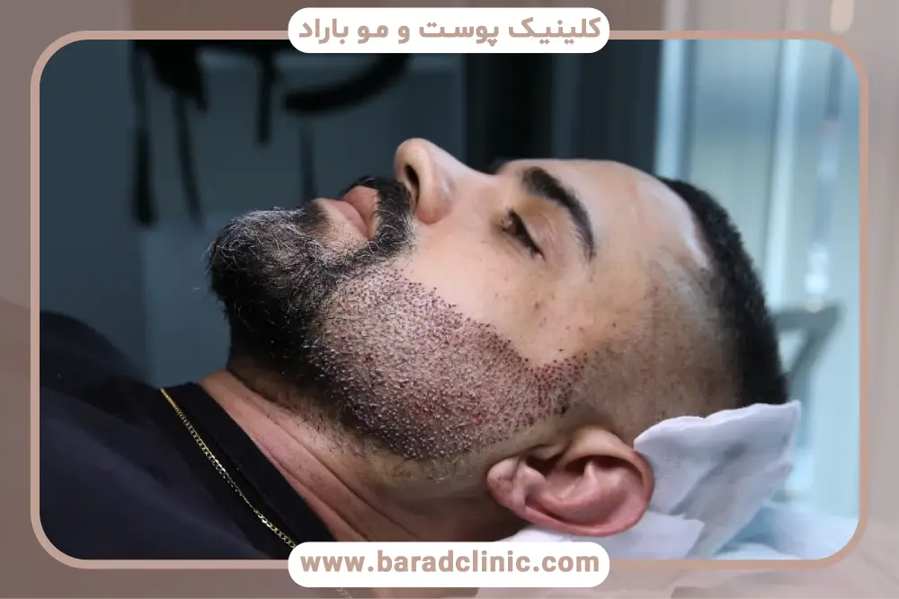 عوارض کاشت ریش بدون جراحی 