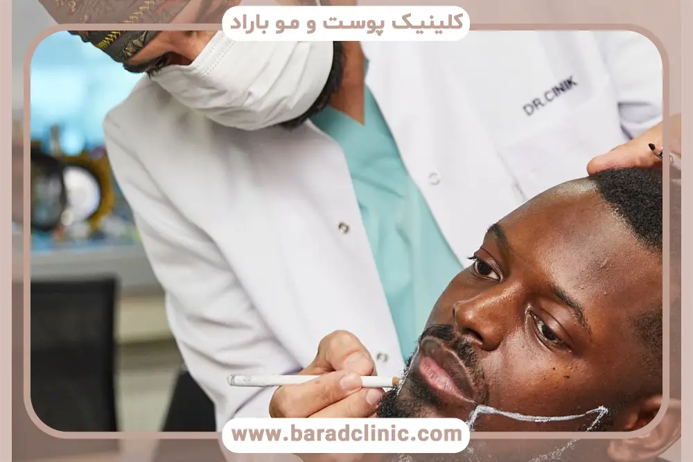 مشاوره کاشت ریش برای افراد کوسه