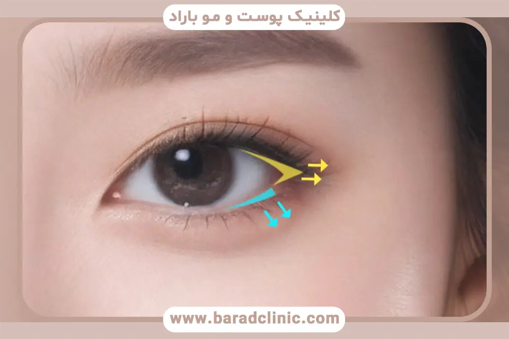 فرق کانتوپلاستی و بلفاروپلاستی در مزایای این دو