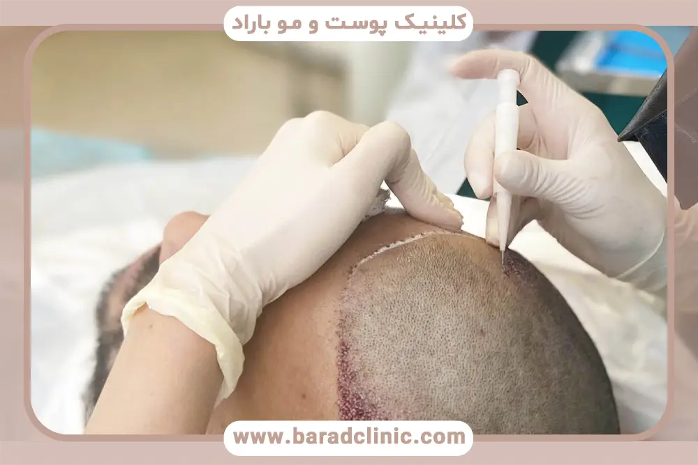 هزینه‌های جانبی کاشت مو