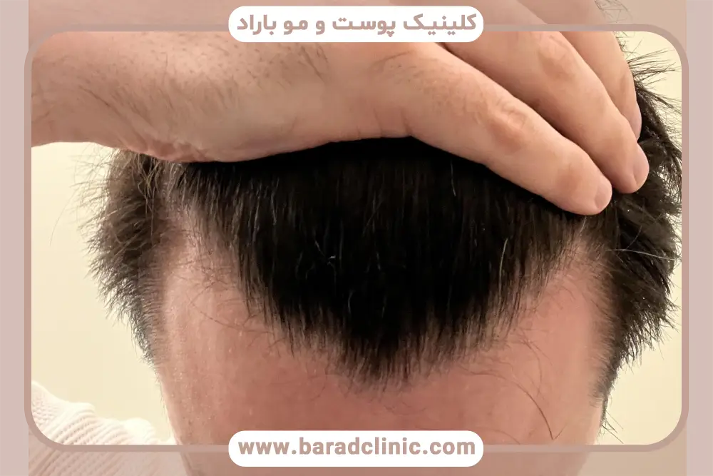 مراحل کاشت مو بدون کچل کردن