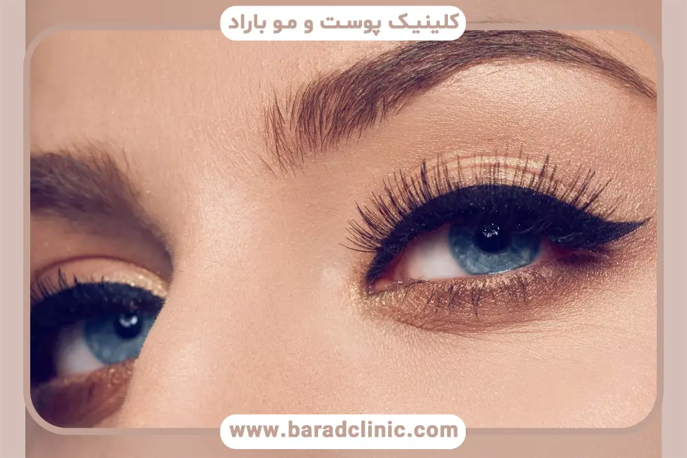 هزینه بلفاروپلاستی جراحی پلک گربه ای