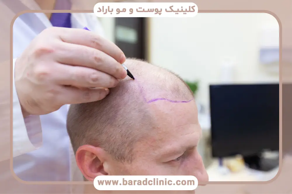 آزمایشهای لازم کاشت موی افراد هپاتیتی