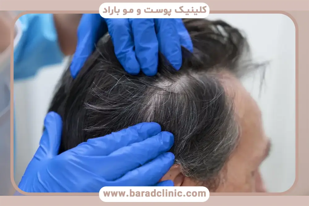 نتایج و ماندگاری کاشت مو به روش fit 