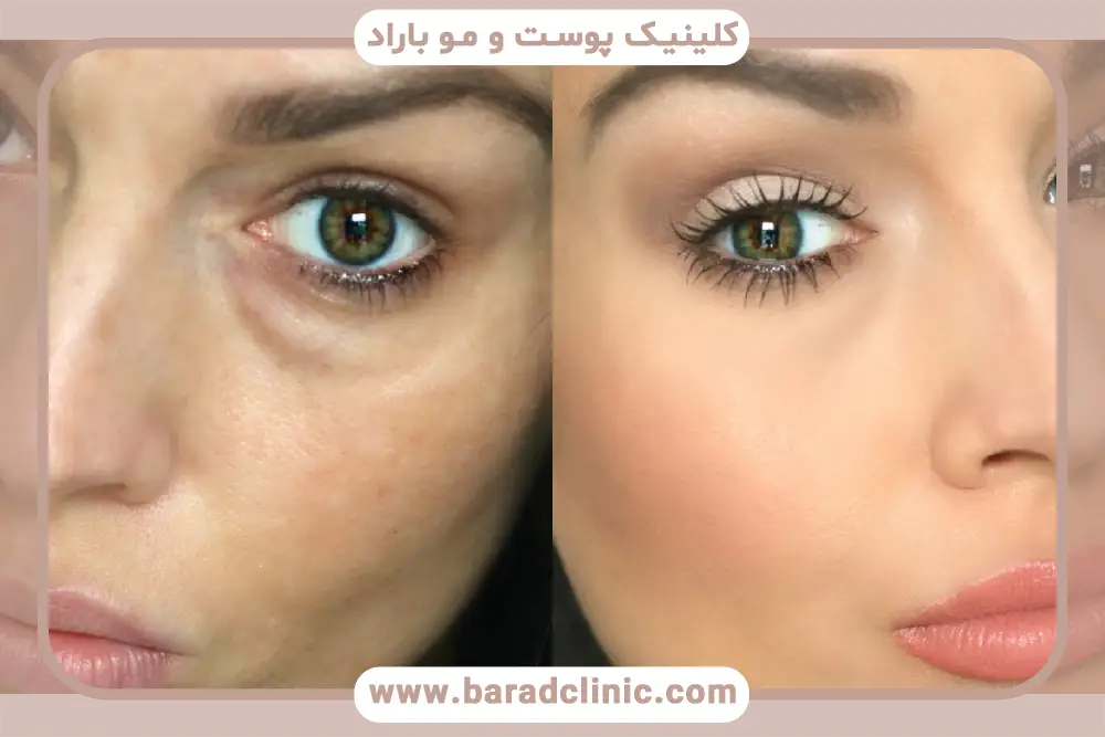 مراقبت‌های بعد از بلفاروپلاستی گودی زیر چشم 