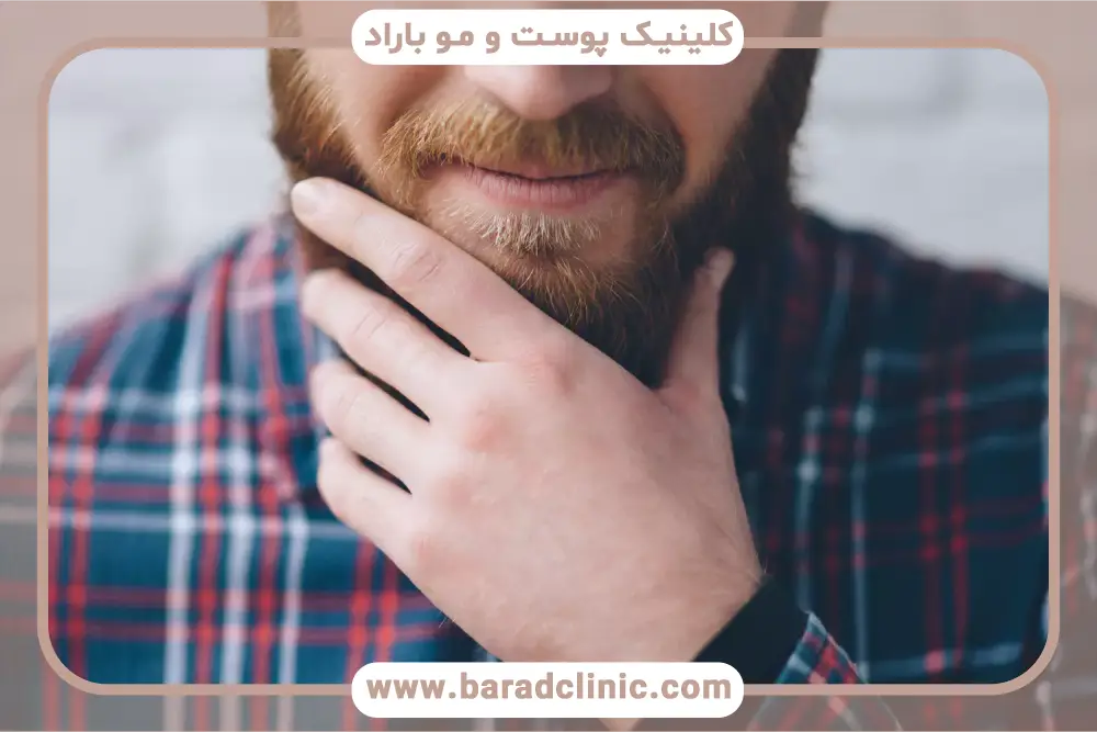 عوارض کم از مهم‌ترین فواید کاشت ریش 