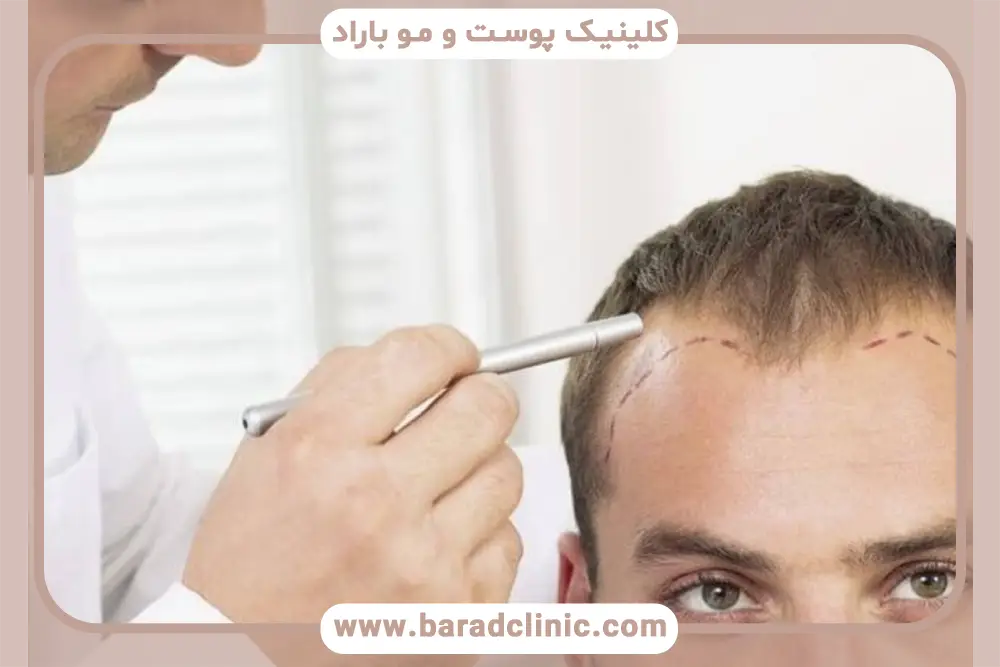 نتیجه کاشت مو بعد از سه ماه در رنگ و ضخامت موها