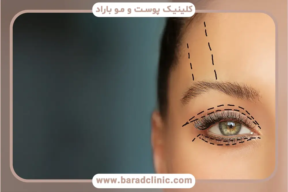 میزان ماندگاری بلفاروپلاستی یا لیفت شقیقه