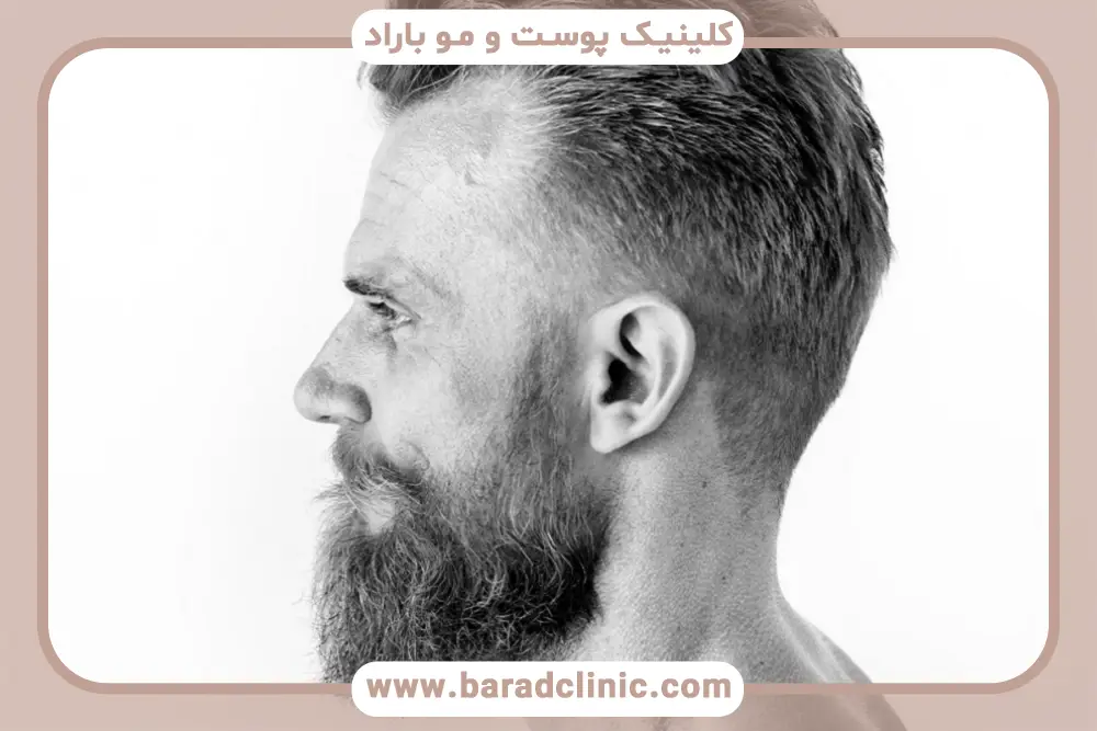 رشد ریش بعد از کاشت ریش در جای بخیه