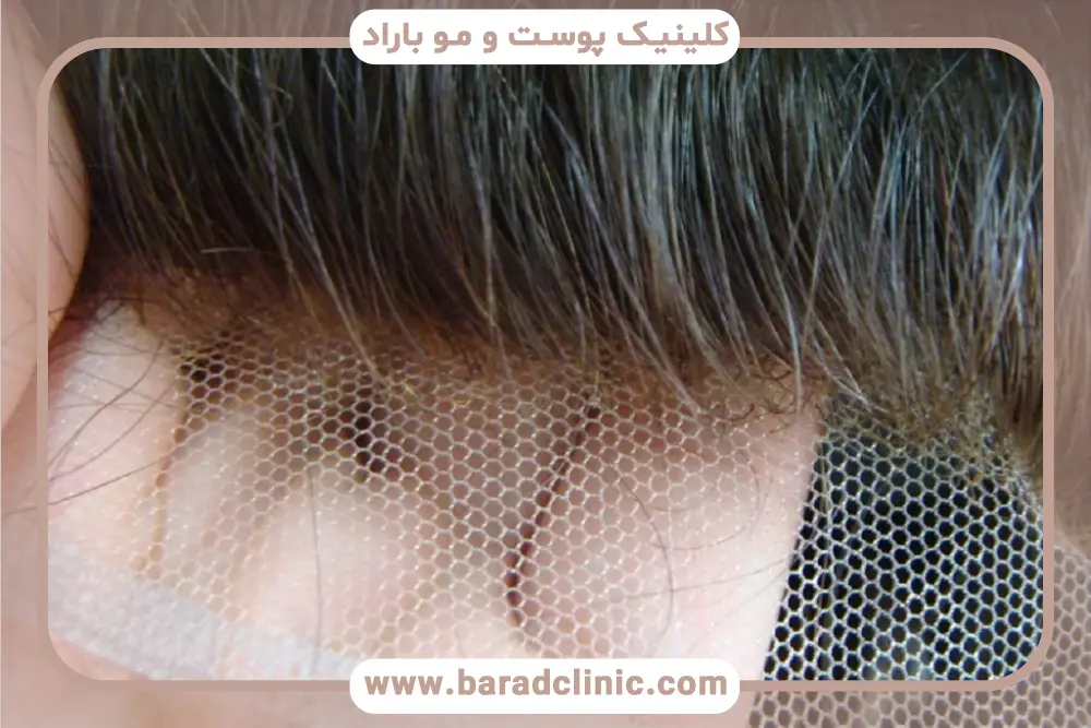 کیفیت تار مو در کاشت مو مصنوعی 