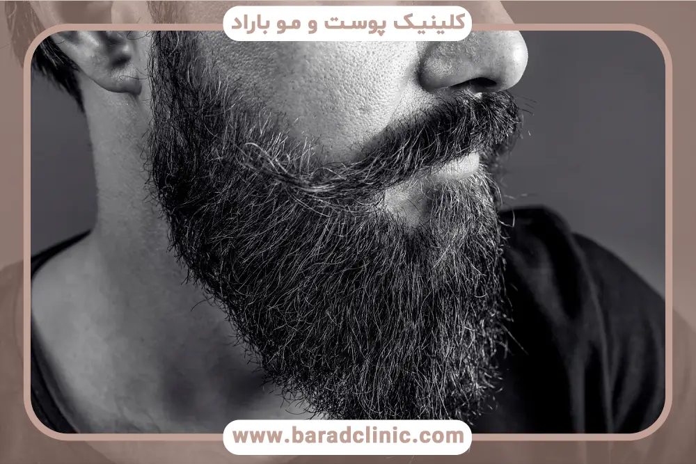 عوارض طبیعی کاشت ریش طبیعی 